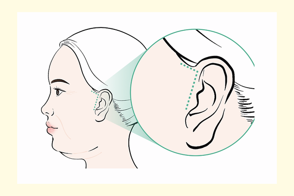 simple-facelift-treatment-areas-busan-600x400.png simple-facelift-treatment-areas-busan-600x400.png