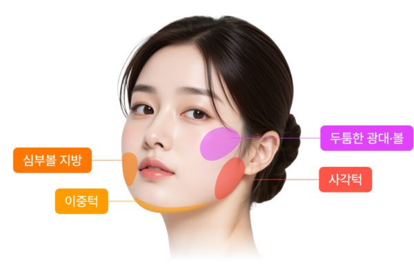 mini-contouring-treatment-areas-600x400.png