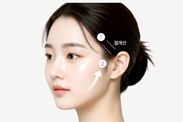 oneday-lifting1-incision-column-bg-600x400.png oneday-lifting1-incision-column-bg-600x400.png