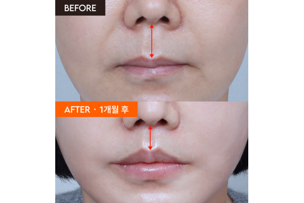 philtrum-reduction-before-after-1month-600x400.png