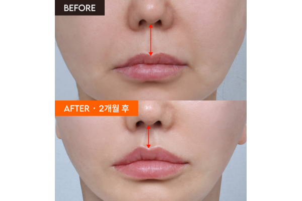 philtrum-reduction-before-after-2months-600x400.png