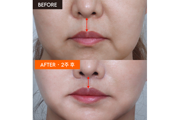 philtrum-reduction-before-after-2weeks-600x400.png