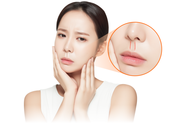 philtrum-reduction-long-philtrum-concern-600x400.png