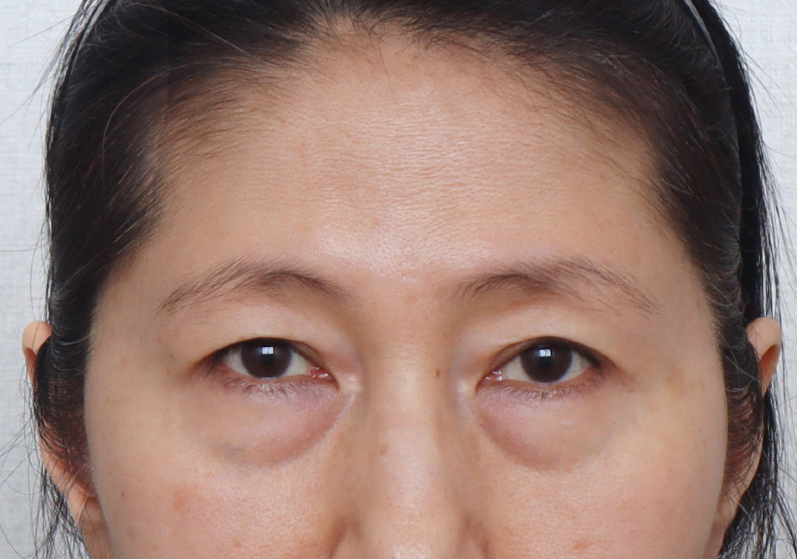 upper_03_before