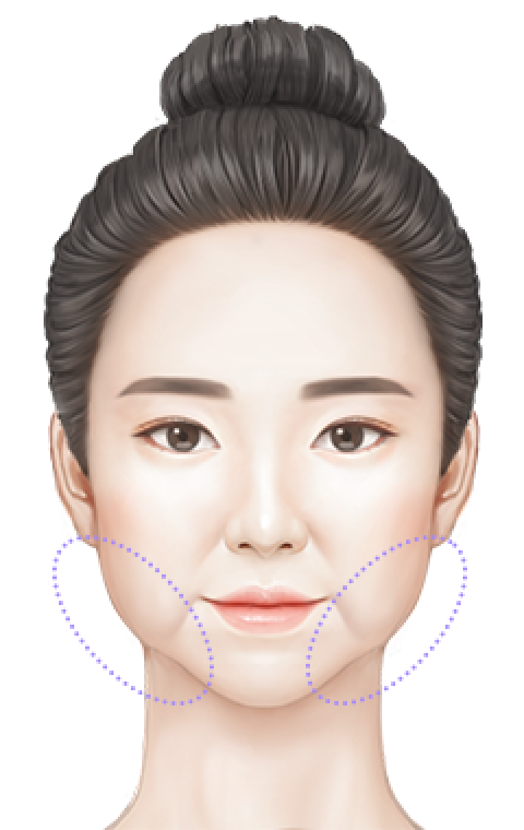 처짐 부위 1