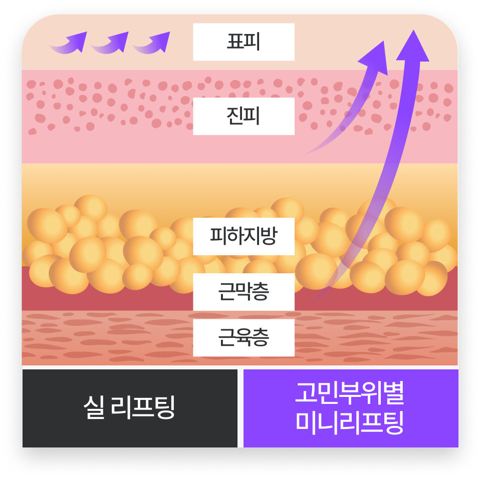 고민부위별 미니리프팅 : 피부와 근막 모두 리프팅