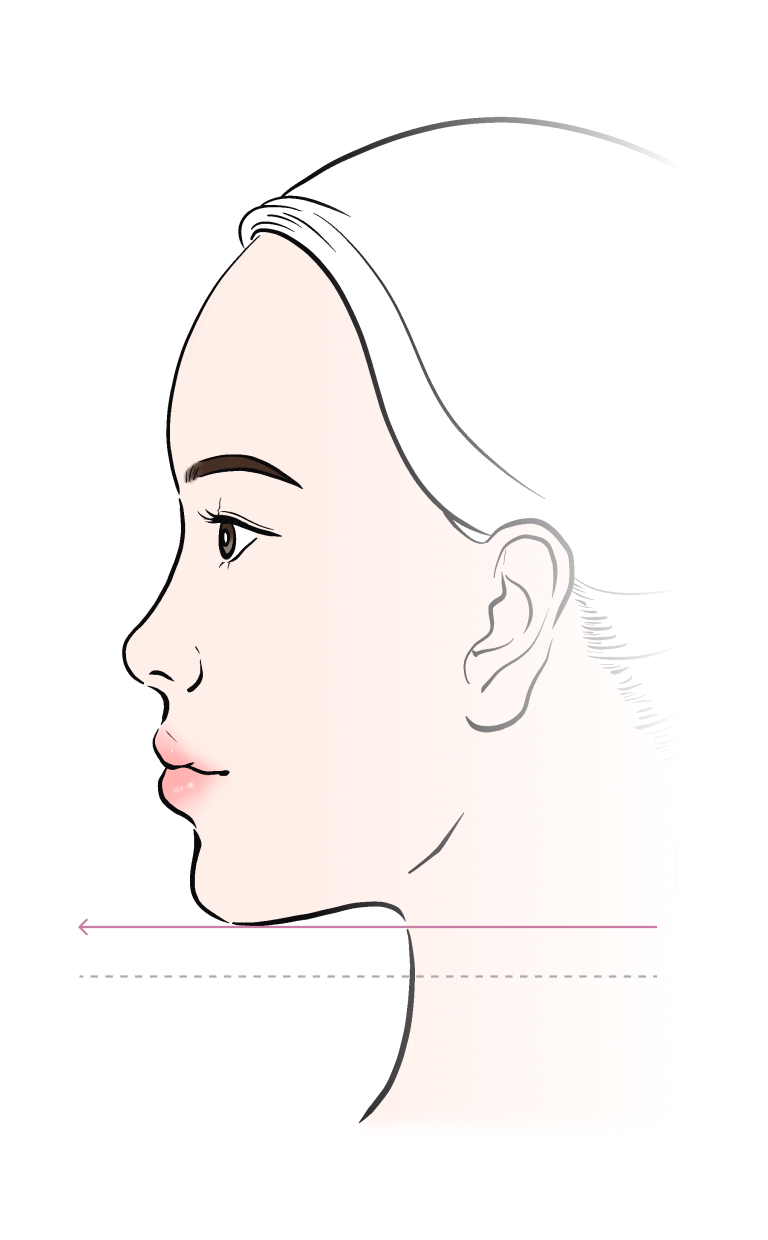 리프팅 후 동안 얼굴