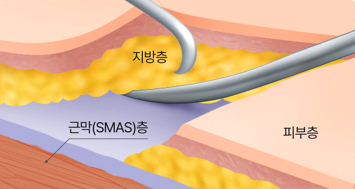 지방층을 당기는 잘못된 박리