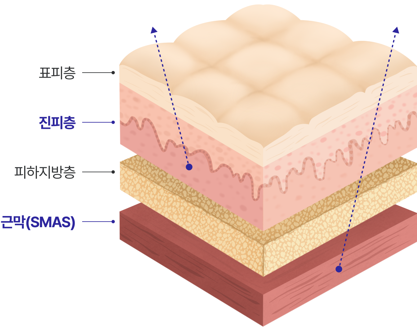 피부 근막(SMAS)층, 피하지방층, 진피층, 표피층