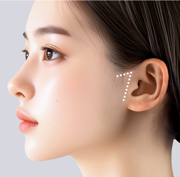 리팅 미니리프팅의 절개라인