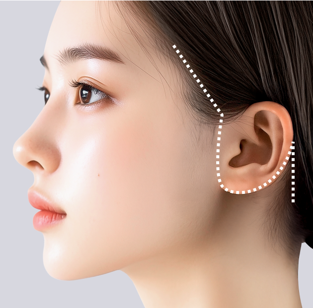 리팅 안면거상의 절개라인