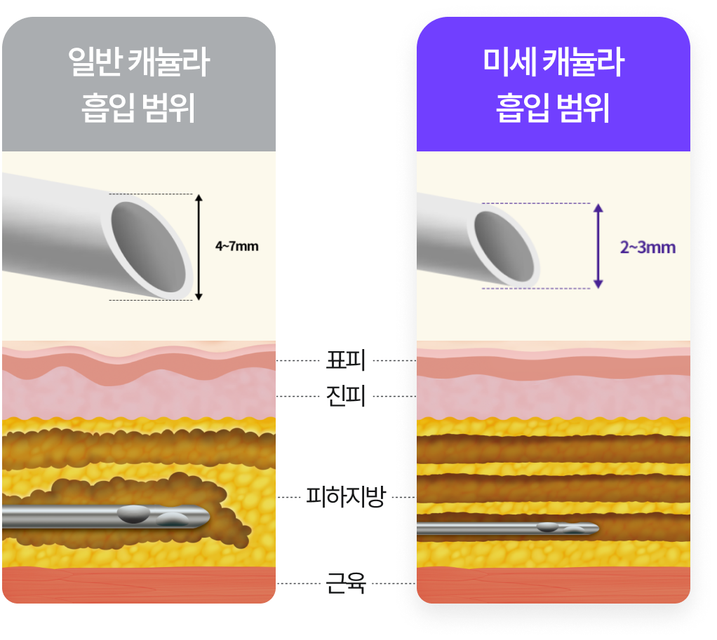 일반 캐뉼라 흡입 범위 : 4~7mm / 미세 캐뉼라 흡입 범위 : 2~3mm(피하지방 손상 적음)