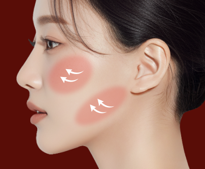 미니윤곽술(단독)