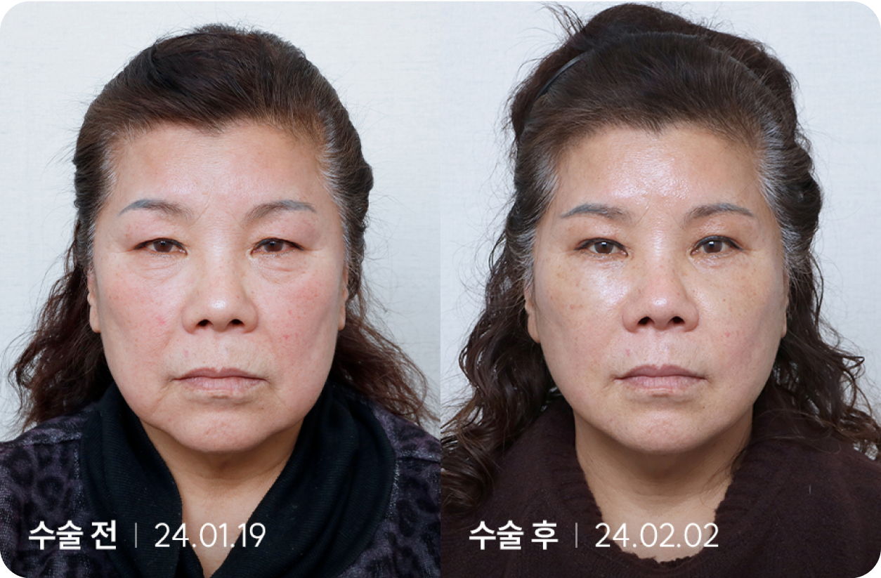 수술 전 | 수술 후