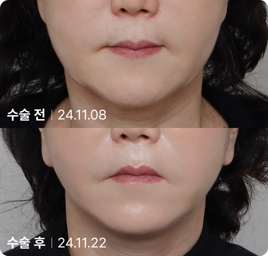 수술 전 | 수술 후