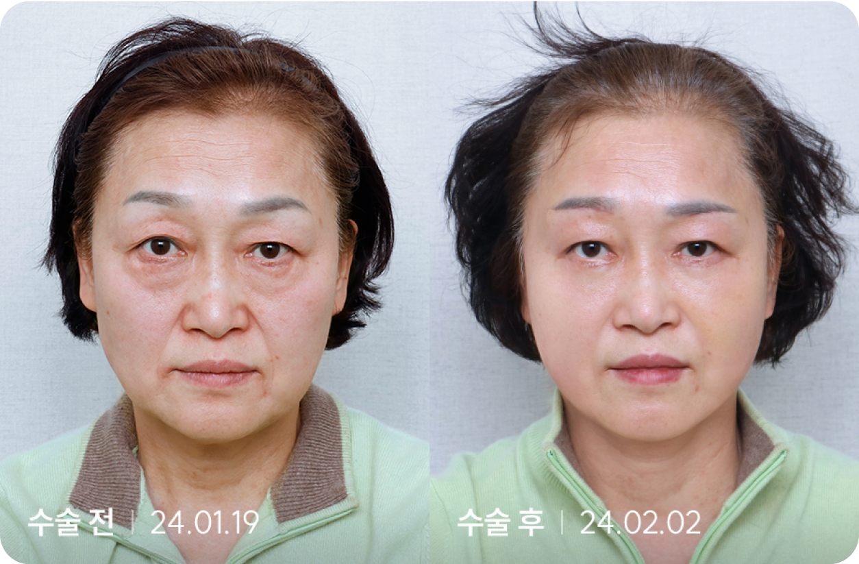 수술 전 | 수술 후