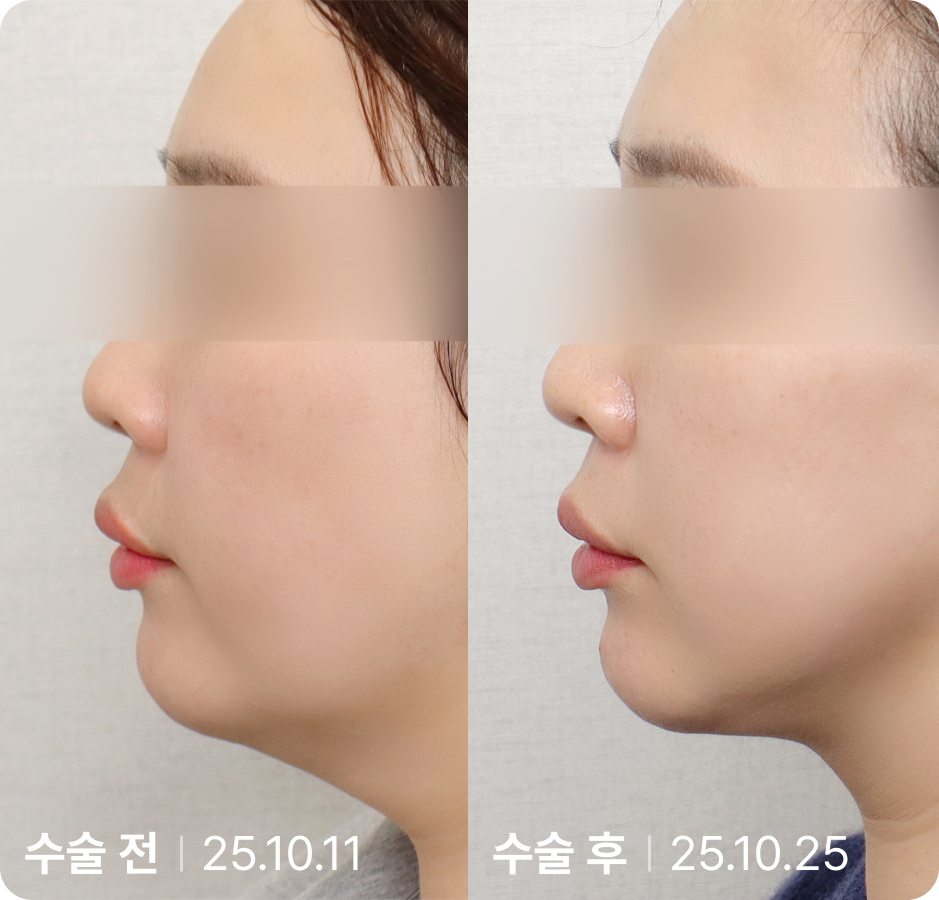 수술 전 | 수술 후