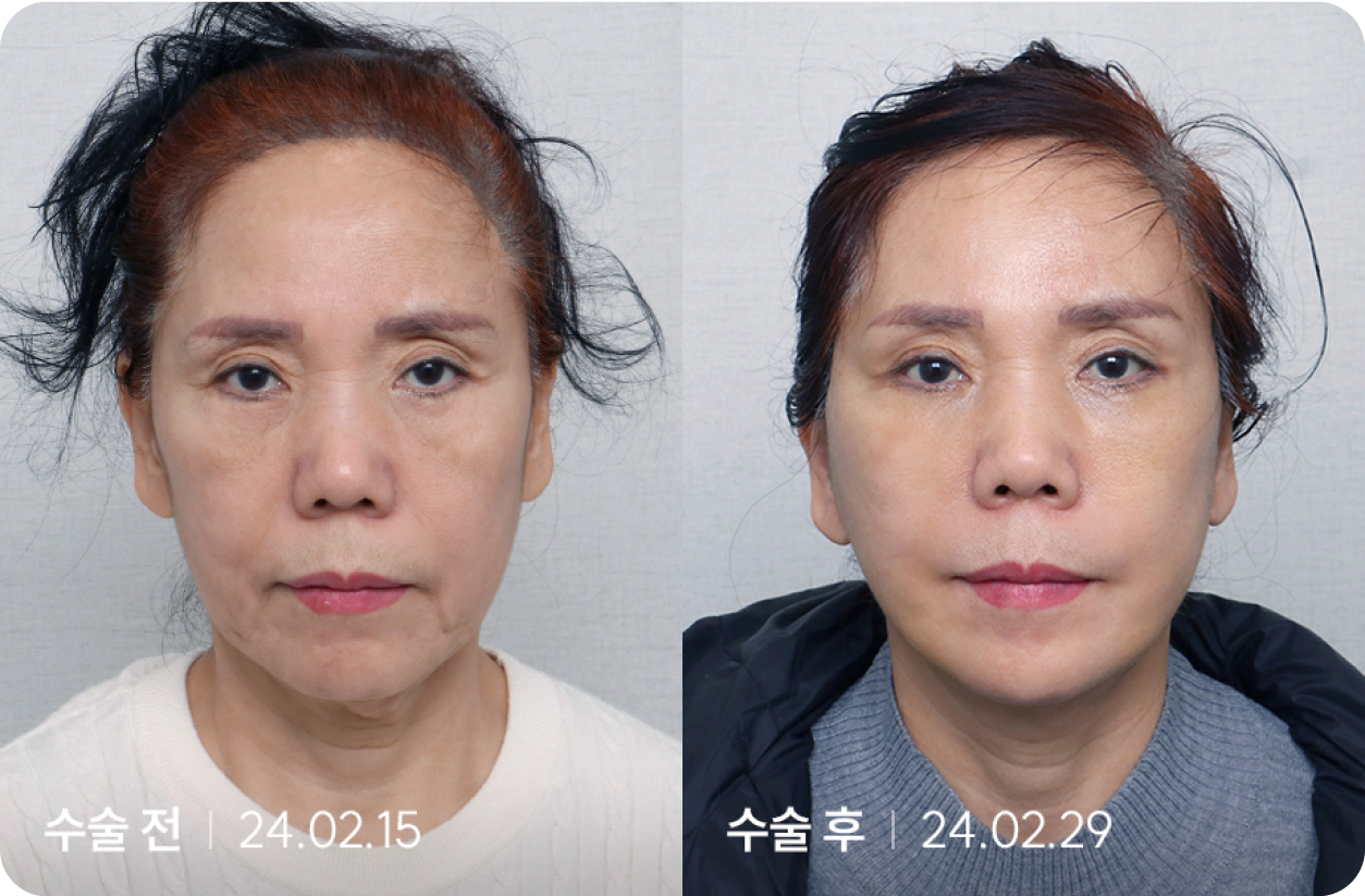 수술 전 | 수술 후