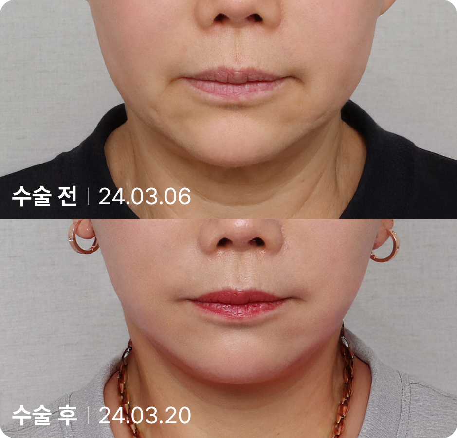 수술 전 | 수술 후