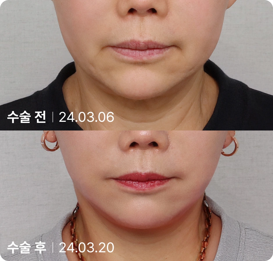 수술 전 | 수술 후