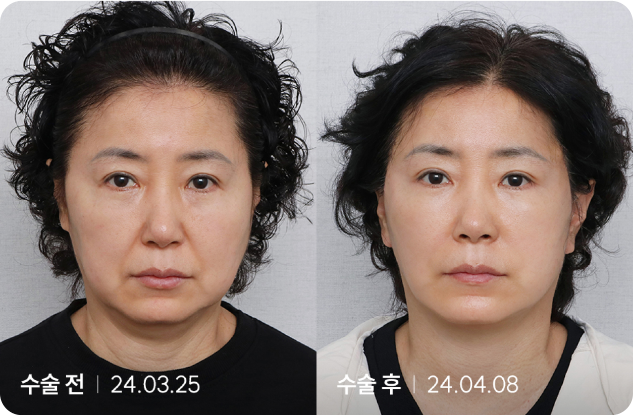 수술 전 | 수술 후