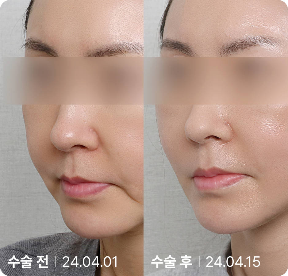수술 전 | 수술 후