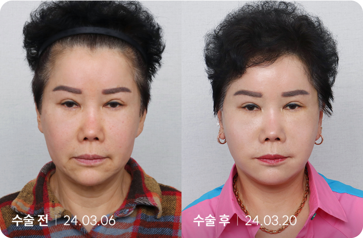 수술 전 | 수술 후