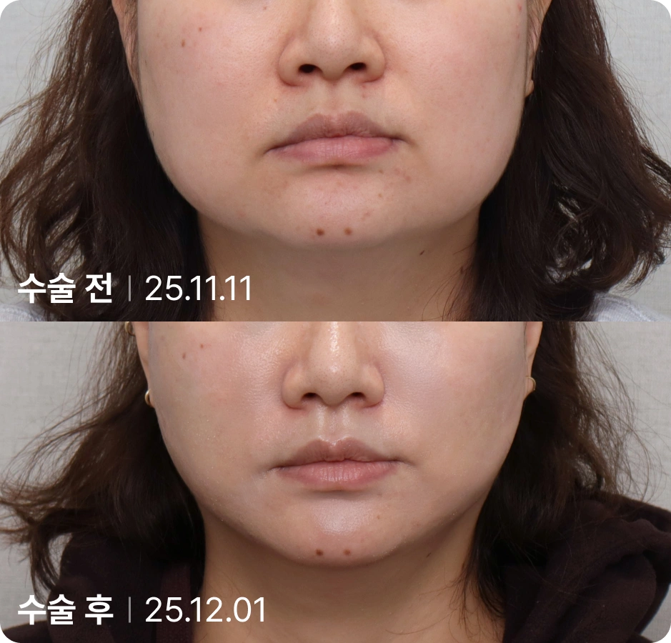 수술 전 | 수술 후