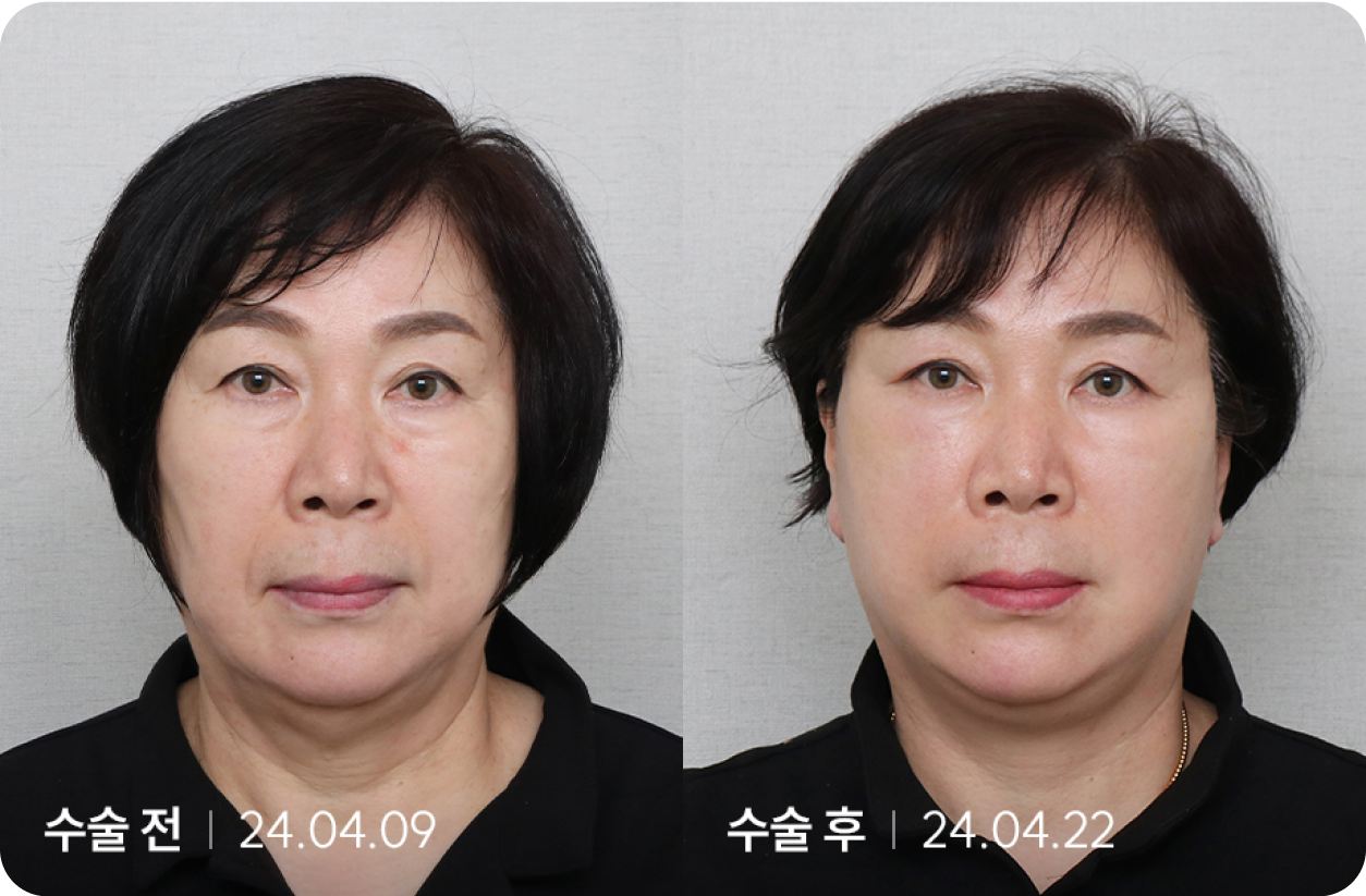 수술 전 | 수술 후