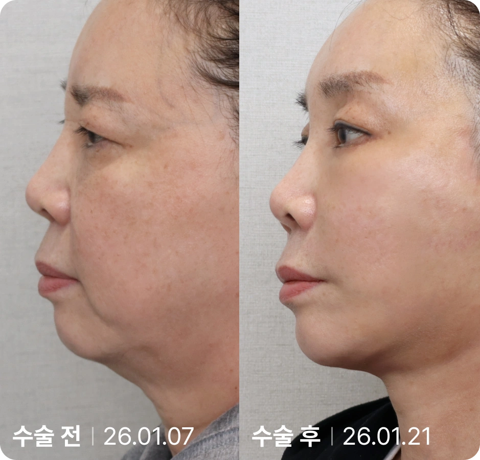 수술 전 | 수술 후
