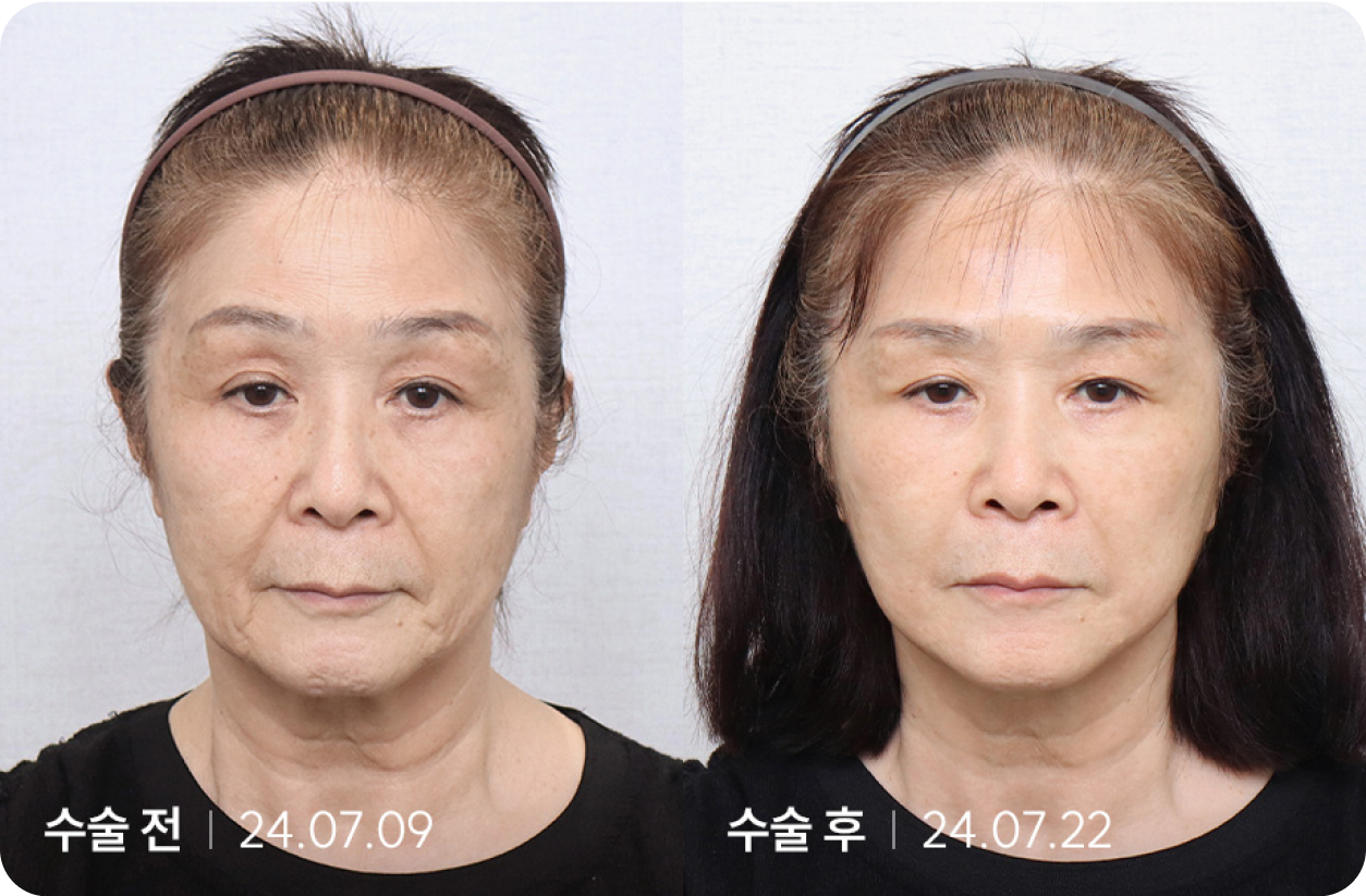 수술 전 | 수술 후