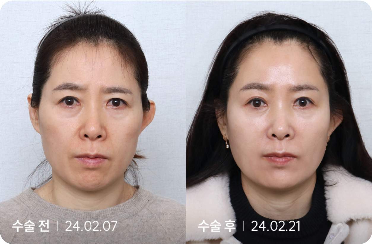 수술 전 | 수술 후