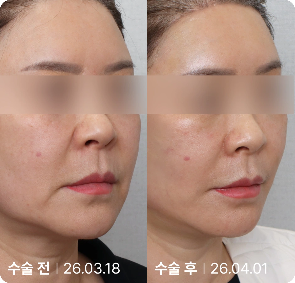 수술 전 | 수술 후