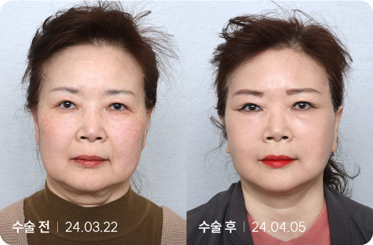 수술 전 | 수술 후