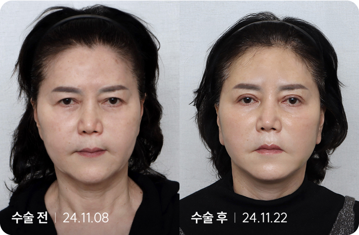 수술 전 | 수술 후