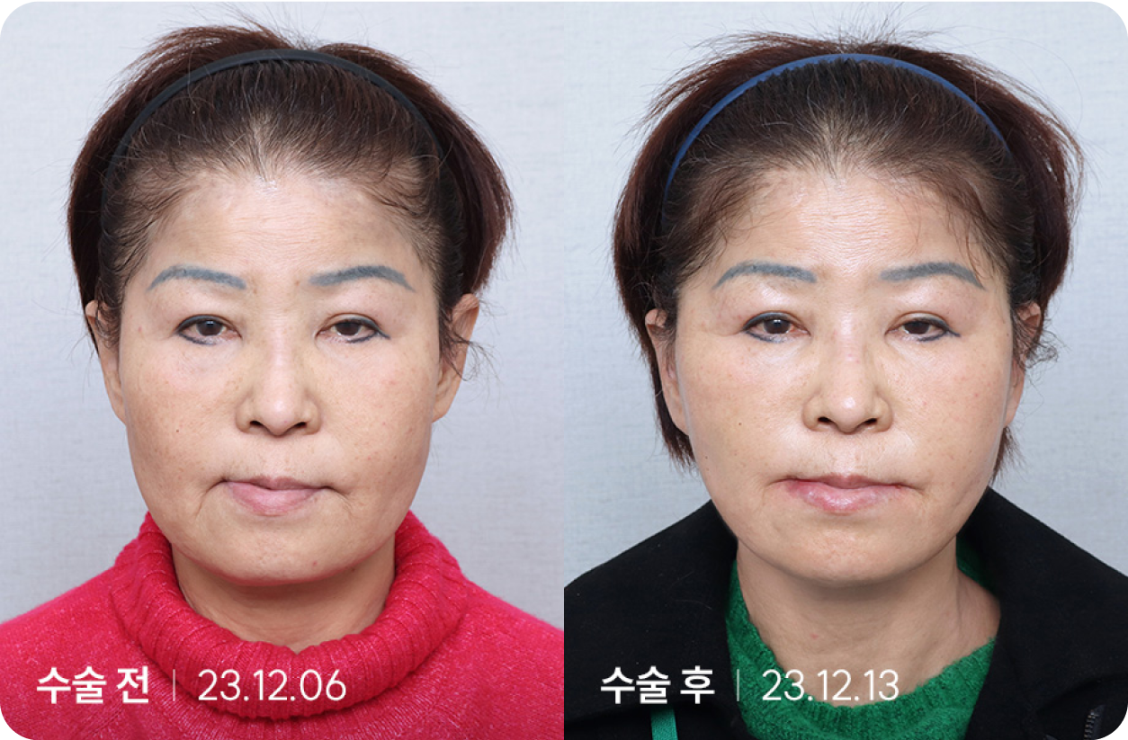 수술 전 | 수술 후