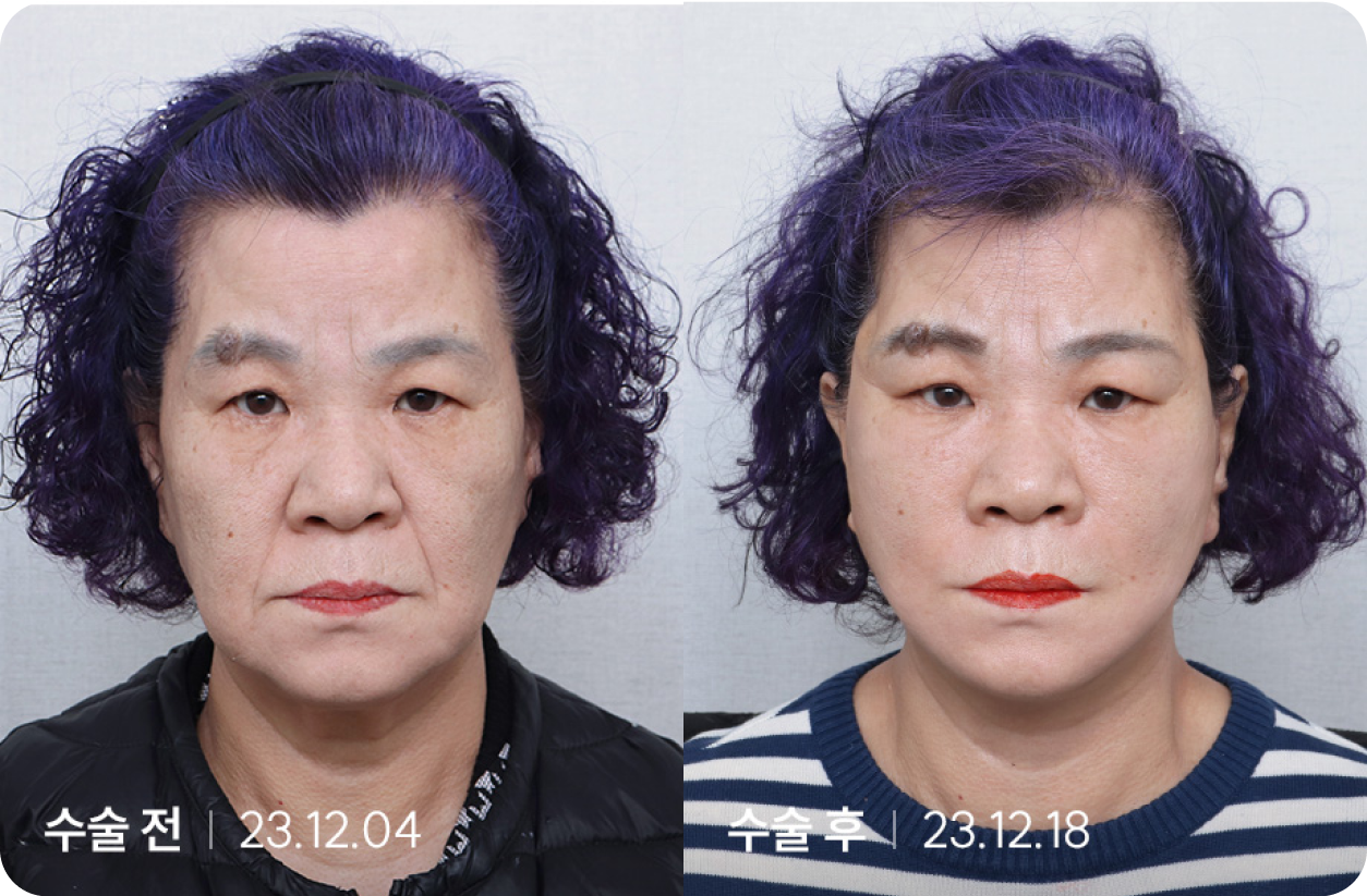수술 전 | 수술 후