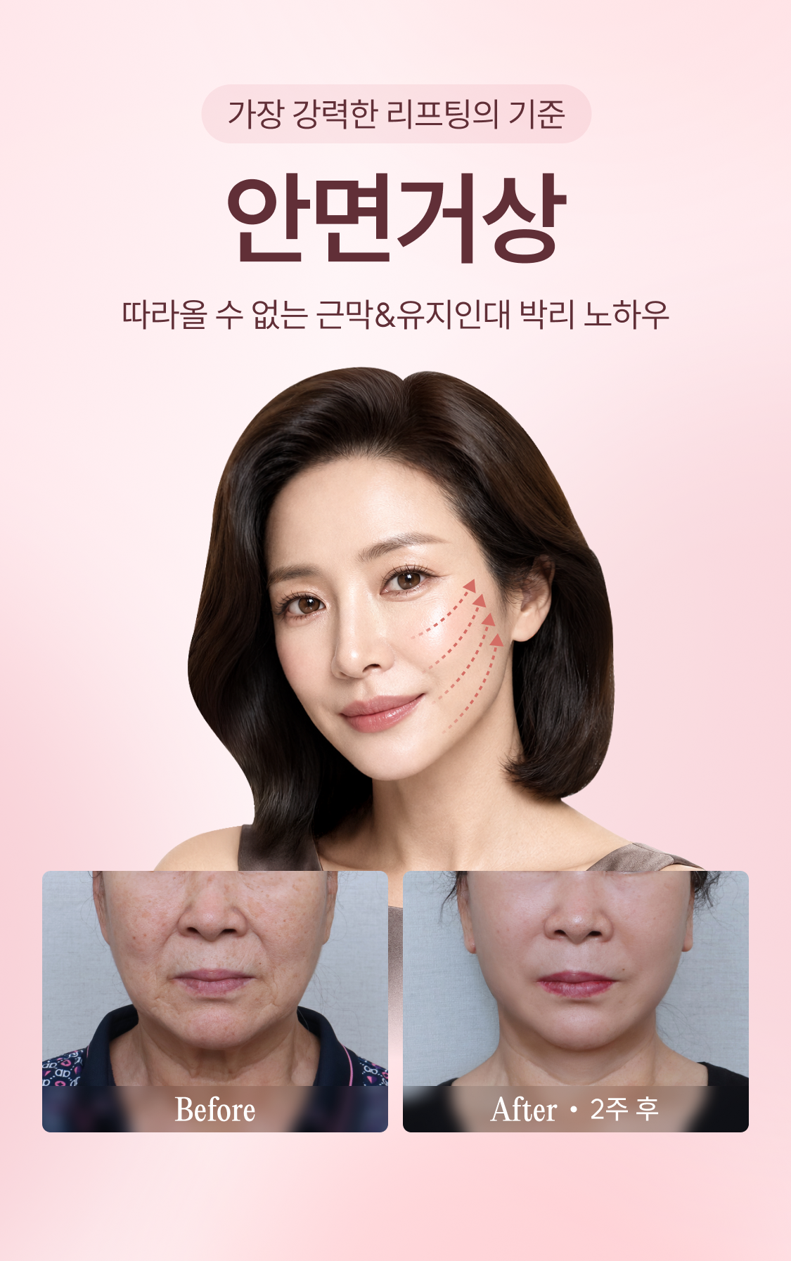 가장 강력한 리프팅의 기준 안면거상