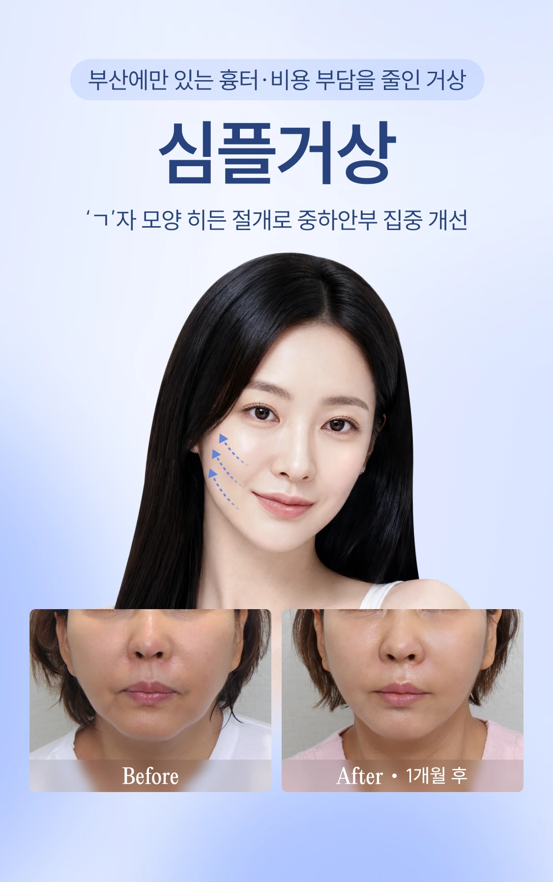 부산에만 있는 흉터·비용 부담을 줄인 거상 심플거상