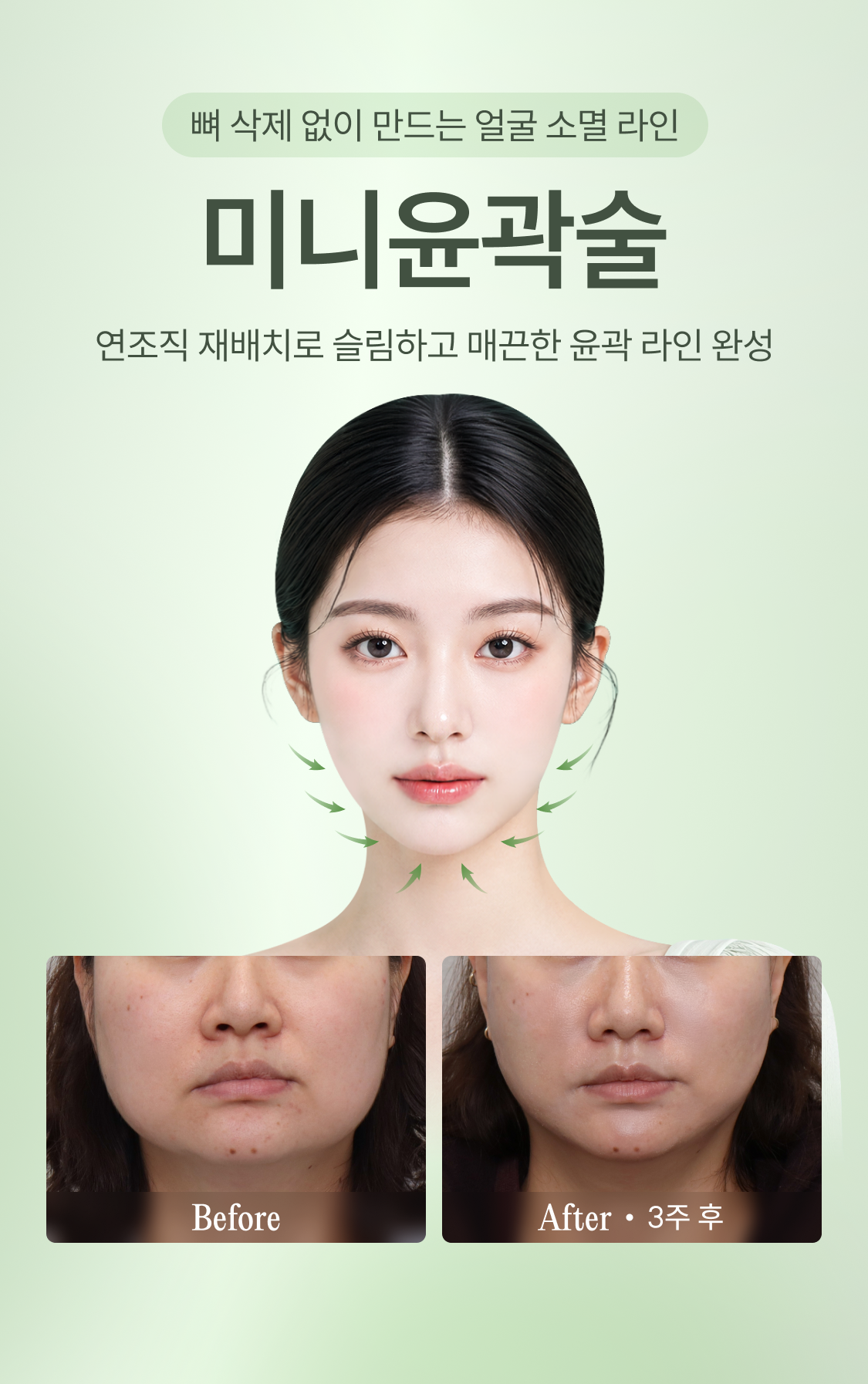 뼈 삭제 없이 만드는 얼굴 소멸 라인 미니윤곽술
